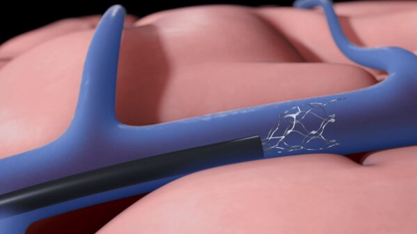 Нейроимплант позволил мужчине управлять iPad силой мысли